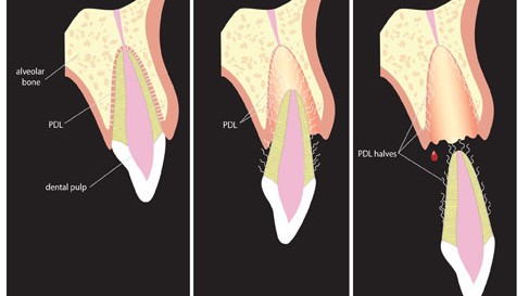 Dent expulsee - avulsion dentaire traumatique